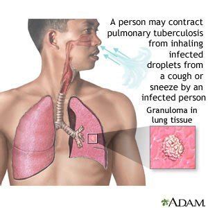 How do you know if cancer treatment is working? Tuberculosis - What You Need to Know