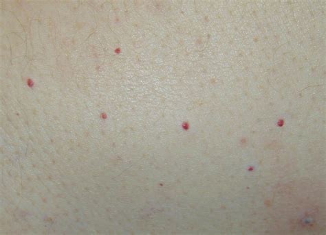 How To Treat Dots Bumps And Red Spots On Skin Skin Spots Body Skin