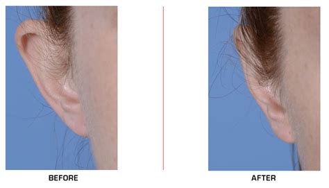 Otoplasty Best Surgeon Ear Surgery Nyc Otoplasty Gallery