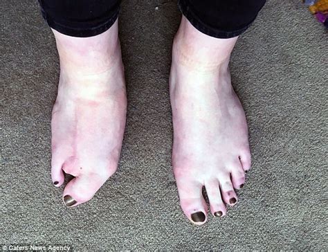 Rare Form Of Gigantism Leaves Matilda Carnegie With Two Toes On Her