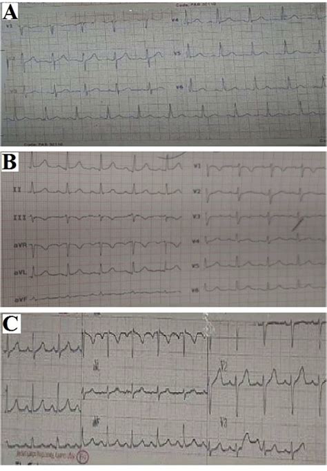Electrocardiogram Ecg A Normal Sinus Rhythm Heart Rate 88 Bpm