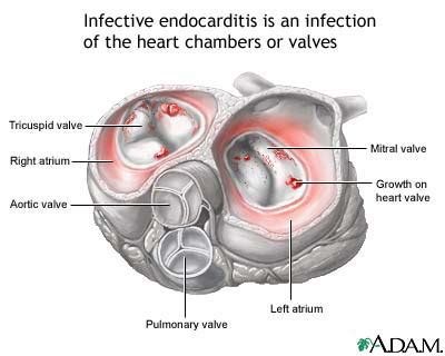 Infective Endocarditis Mitral Valve