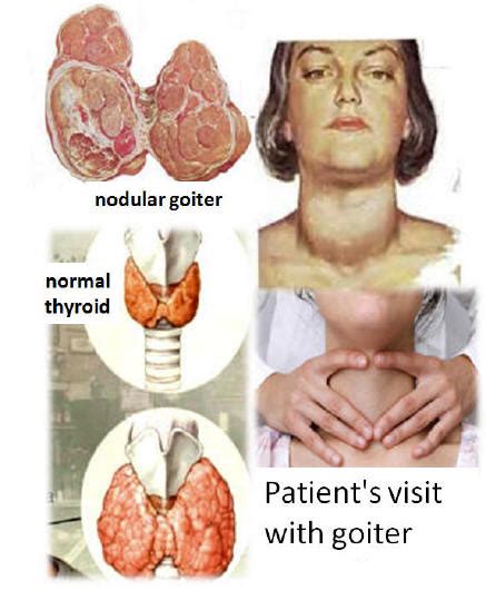 Goiter Hypothyroidism