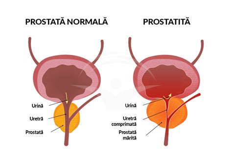 Ce Simptome Dau Calcifierile La Prostata Prostaffect N Rom Nia Hot Sex Picture
