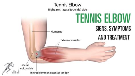 Tennis Elbow Signs And Symptoms And Treatment Of The Common Elbow