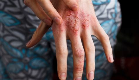 What Is Dermatitis