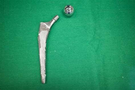 Photo Of Grandmas Titanium Hip Joint Left Behind After Cremation Goes