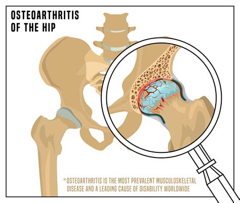 Hip Osteoarthritis Physio Simply Align Rehab