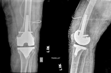 Ap And Lateral Radiographs Showing Fixation Of Medial Condyle Fracture