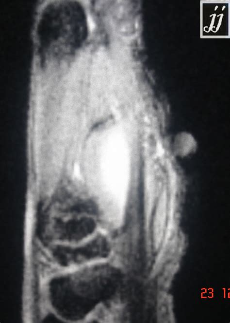 Radioogle Msk Ganglion Cyst Around Flexor Tendon Hand Sagittal T2 2