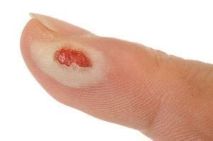Download in under 30 seconds. Home Remedies for Burns