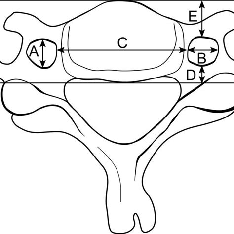 Mean Cervical Spine Transverse Foraminal Dimensions Mm Download Table
