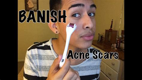 Get Rid of Acne Scars with BANISH - YouTube