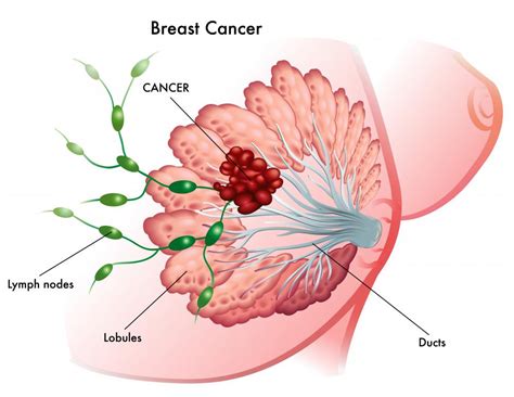 Top 10 Warning Signs Of Breast Cancer Kanigas