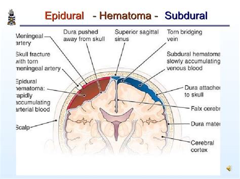 Subdural Vs Epidural Hematoma Radiology Wrocawski Informator