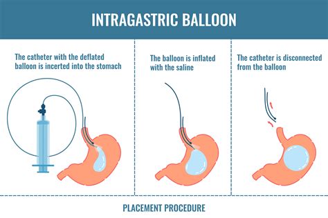 Gastric Balloon Dubai Gastroenterology Clinic