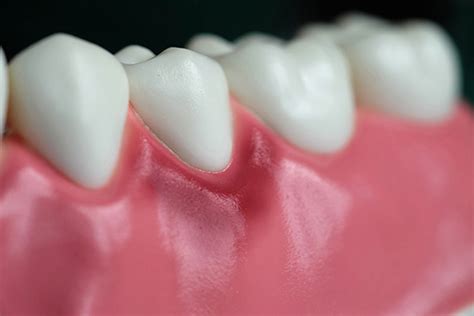 A Primer On Gum Disease Treatment