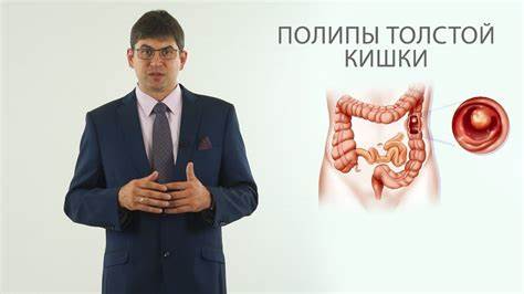 Полип толстой кишки диета полипы толстой кишки (полип анального канала, полип прямой кишки) - YouTube полипы толстой кишки (полип анального канала, полип прямой кишки) - YouTube Полип толстой кишки диета