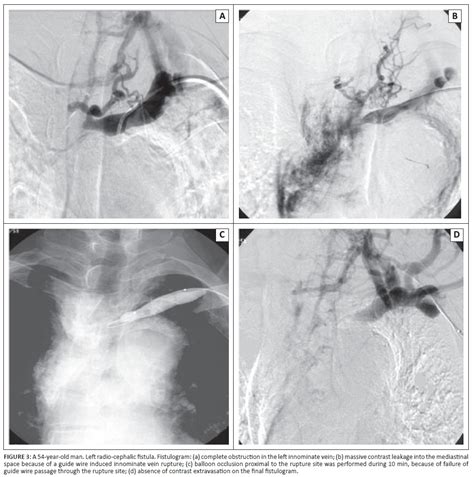 Central Vein Rupture During Percutaneous Transluminal Angioplasty For