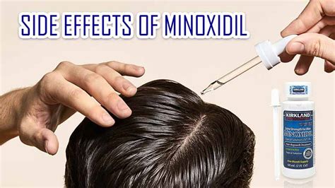 understanding minoxidil unwanted side effects
