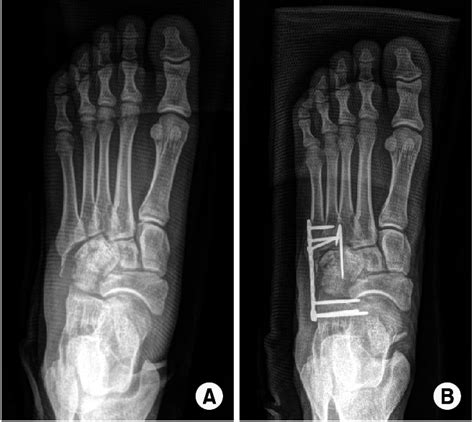 A Nutcracker Fracture Of Cuboid Was Seen On An Anteroposterior