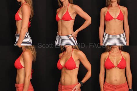 Before And After Breast Augmentation A To B Cosmetic Surgery Tips