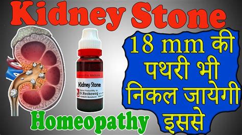 Kidney Stone Homeopathic Medicine Renal Stone Homeopathic Medicine