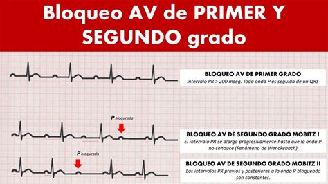 Cardiotruco Bloqueos Av Cardioprimaria Ferrol