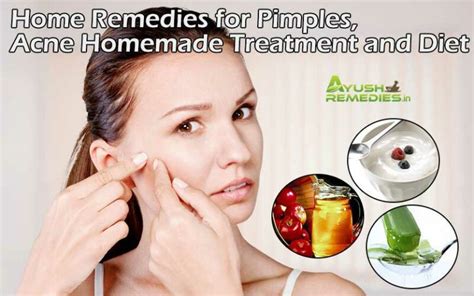 Home Remedies For Pimples Acne Homemade Treatment And Diet