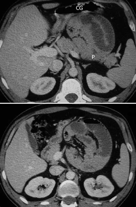 Axial Enhanced Ct Demonstrates A Cluster Of Dilated Jejunal Loops