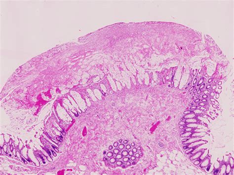 Browse the use examples 'colocolostomy' in the great english corpus. 020BClostr.Diff.Ind.Colotis (low)