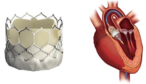 Combined Opcab And Tavr May Be An Option Keystone Perfusion
