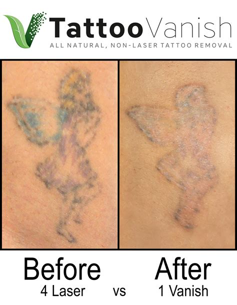 Keep in mind that the skin in its natural state works best for laser tattoo removal. Best Tattoo Removal in Miami | All-Natural & Non-Laser ...