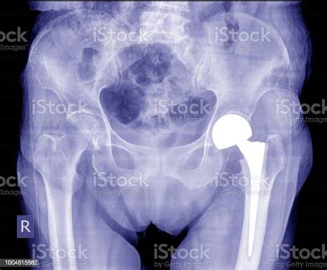 Xray Image Post Operation Total Hip Replacementtotal Hip Arthroplasty