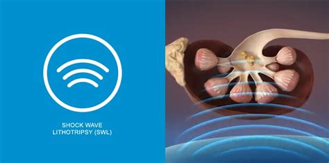 Shock Wave Lithotripsy Swl My Kidney Stone Boston Scientific