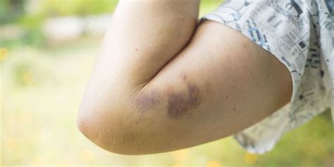 Why Do I Bruise So Easily 8 Odd Causes Of Bruising Easily