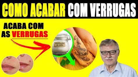 Remédio Caseiro Para Verruga