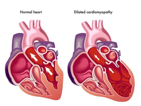 Cardiomyopathy What Causes An Enlarged Heart University Health News