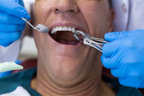 I need a tooth pulled immediately. Tooth Extractions in La Mesa California | Trinity Family ...