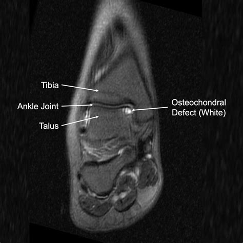 Osteochondral Lesion Of The Talus