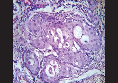 Photomicrograph Showing Squamous Metaplasia Of The Ducts A Bland