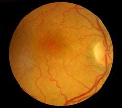 Tritt dieser plötzlich und im auge auf, ist von einer anterioren ischämischen optikusneuropathie die durch die schleichende verengung der blutbahnen können sich blutgerinnsel, auch thrombus. Thrombose im Auge