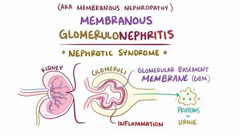 Membranous Nephropathy Video Anatomy And Definition Osmosis