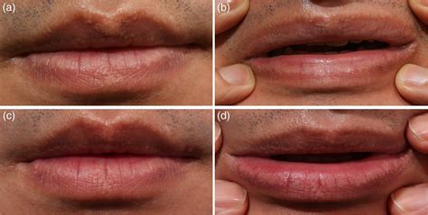 Fordyce Spots On Lips Home Remedy Lipstutorial Org Hot Sex Picture