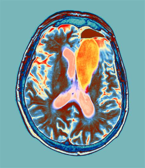 Brain Cancer Treatment Mri Scan Photograph By Du Cane Medical Imaging