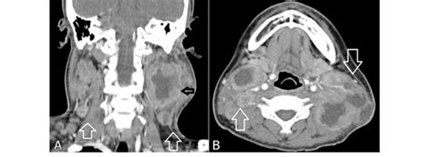 A Axial Ct Picture Showing Multiple Enlarged Cervical Submandibular