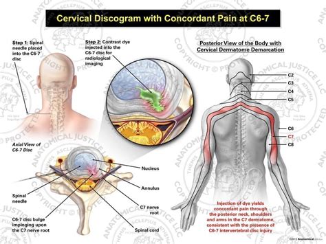 Male Left Cervical Discogram With Concordant Pain At C6 7