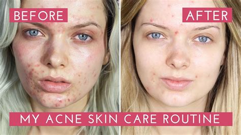 Maybe you would like to learn more about one of these? My Acne Skin Care Routine // How I Cleared My Acne ...