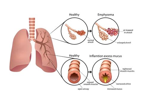 Diferencia Entre Bronquitis Cr Nica Y Enfisema Campus Kin Sico