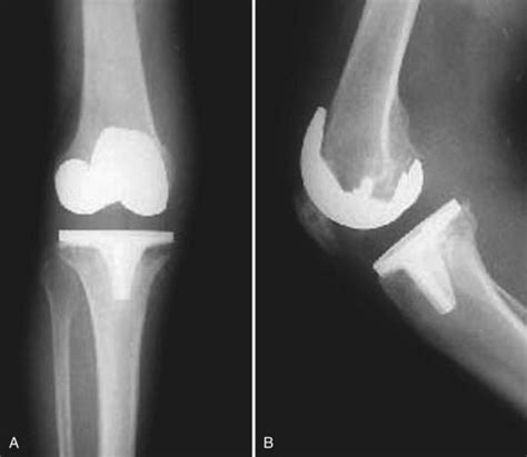 The Infected Total Knee Replacement Musculoskeletal Key